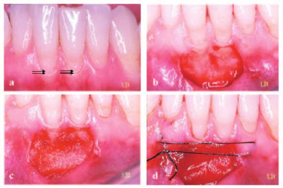 Figure 5. Case #6. a) The extremely reduced amount of gingiva (arrows) near the lower central incisors causes discomfort for the patient during daily oral hygiene. b) The exposed periosteum.