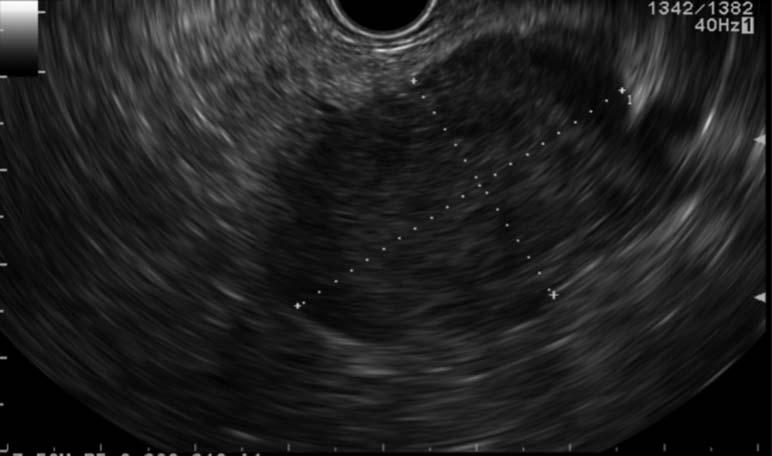 Multiple Endocrine Neoplasia Type 1 Figure 2. Endoscopic ultrasound shows the corresponding 4.2 2.7 2.8-cm heterogeneously echogenic mass at the pancreatic body that was biopsied.