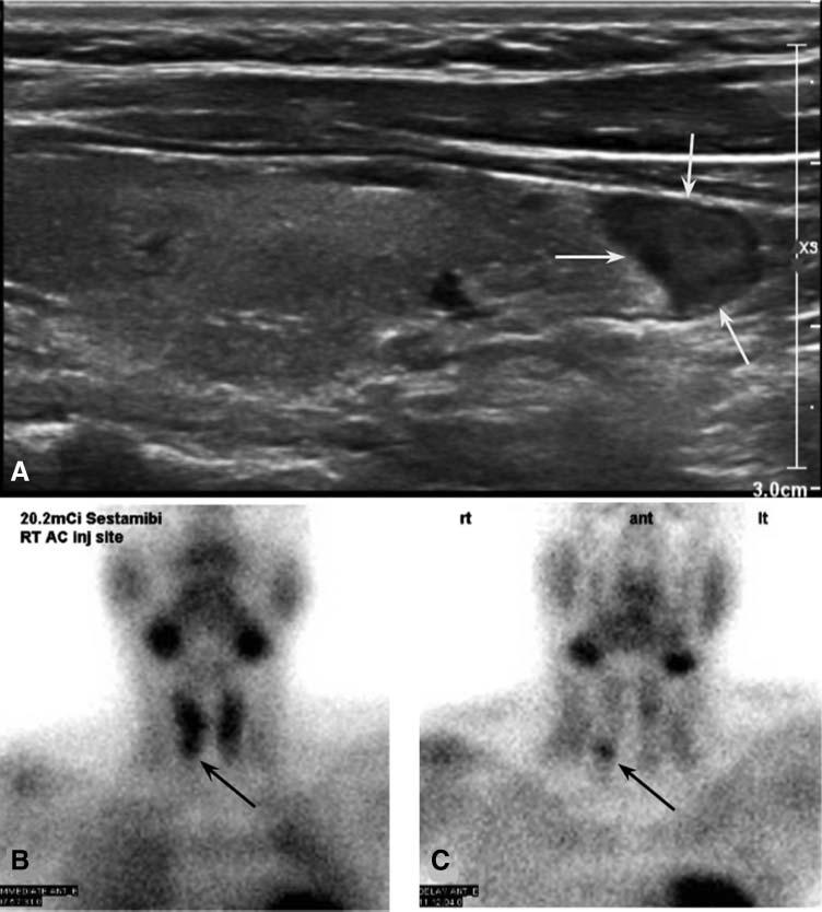 Keller, HR Figure 4. Longitudinal ultrasound (A) through the right lobe of the thyroid gland demonstrates a hypoechoic nodule inferior to the right lobe (white arrows).