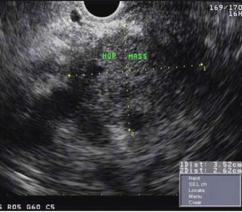 Endoscopic ultrasound images of pancreatic