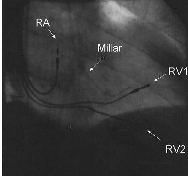 OPTIMIZER System implant One lead is placed in RA, and two leads are placed on the RV septum (RV1, RV2) approximately
