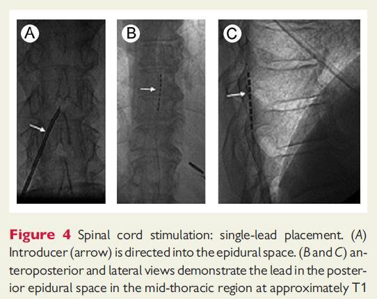 Spinal Cord Stimulation Page