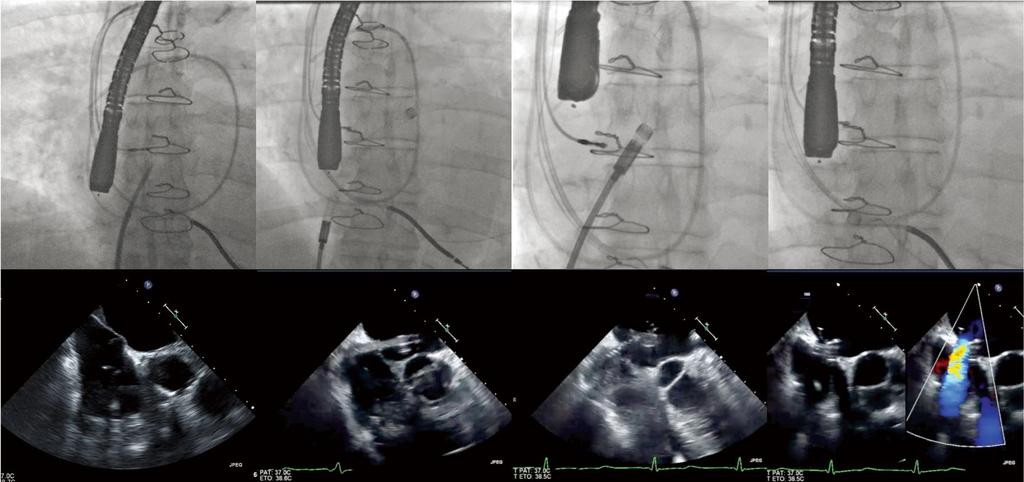 Left to Right interatrial