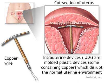 IUD: Contragestive The Pill Contraceptive