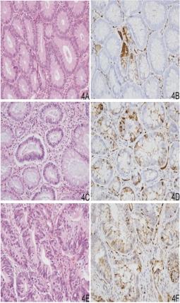 W.-C. Tsai et al. / Fascin-1 in colorectal cancer 157 Fig. 4.