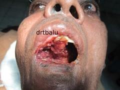 nasal discharge 