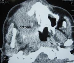 Axial CT cut showing