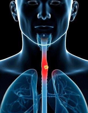 Oesophageal Cancer Two types of oesophageal cancer: ESCC Oesophageal Squamous-Cell Carcinoma OAC Oesophageal Adenocarcinoma OAC is the 8 th most common cancer globally (2012