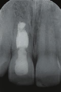 2 Tooth 11 exhibits a chronic infection with a fistula in the peri-apical region. Fig. 3 The dental X-ray shows the rooted tooth 11.
