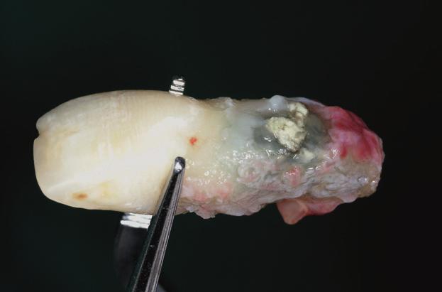 biotype Thick biotype, low-scalloped Medium scalloped, medium thick Thin biotype, high scalloped Tooth crown shape Rectangular Triangular Alveolar infection status