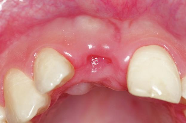 11 The intra-operative occlusal view clearly shows the excellent ridge breadth (> 6 mm) in the region of the
