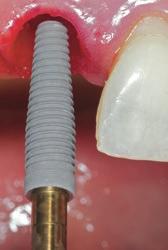 It is a versatile, easy-to-use implant which performs well in soft and hard bone.