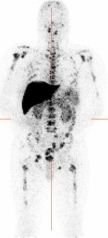 J591 PSMA- Targeted PET Scan SubstanLal improvement over convenlonal imaging (bone, CT, MR,