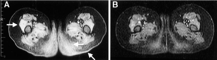 MRI Before therapy After