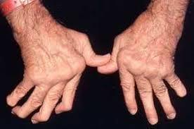 Clinical manifestations The disease may present as a polyarticular arthritis with a gradual onset, intermittent or migratory joint involvement, or a monoarticular onset.