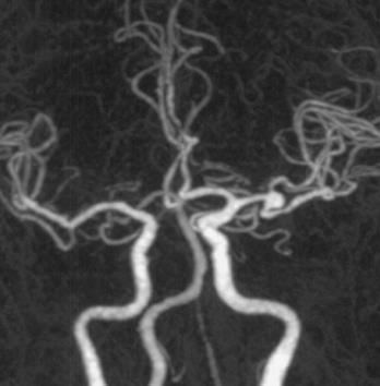 bifurcation aneurysm