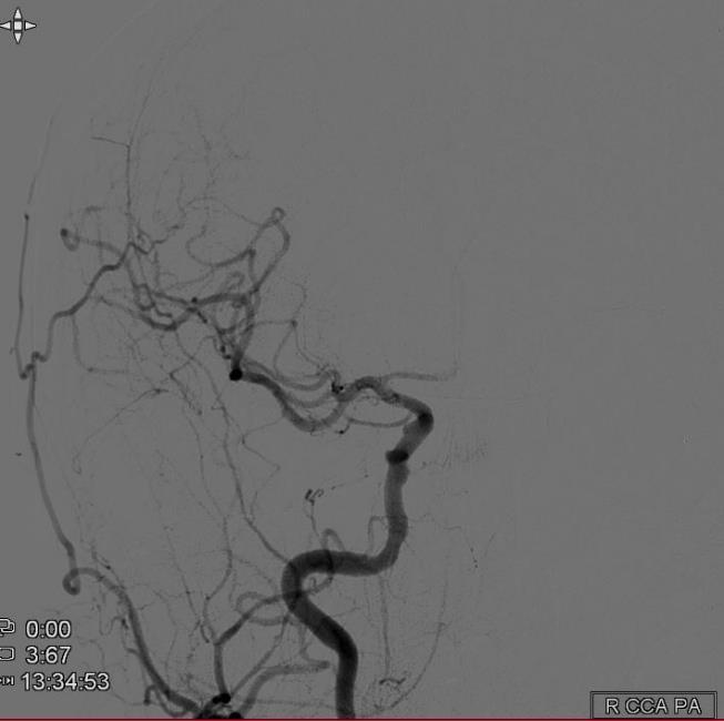 R ICA stenosis