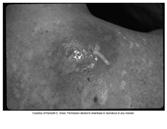 Benign tumor of the skin include: Skin tags. Lipomas (benign fatty tumors).