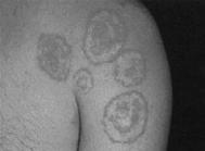 TINEA CORPORIS TINEA CRURIS TINEA CAPITIS Inflammatory Disorders of the Skin: Dermatitis/Eczema In current