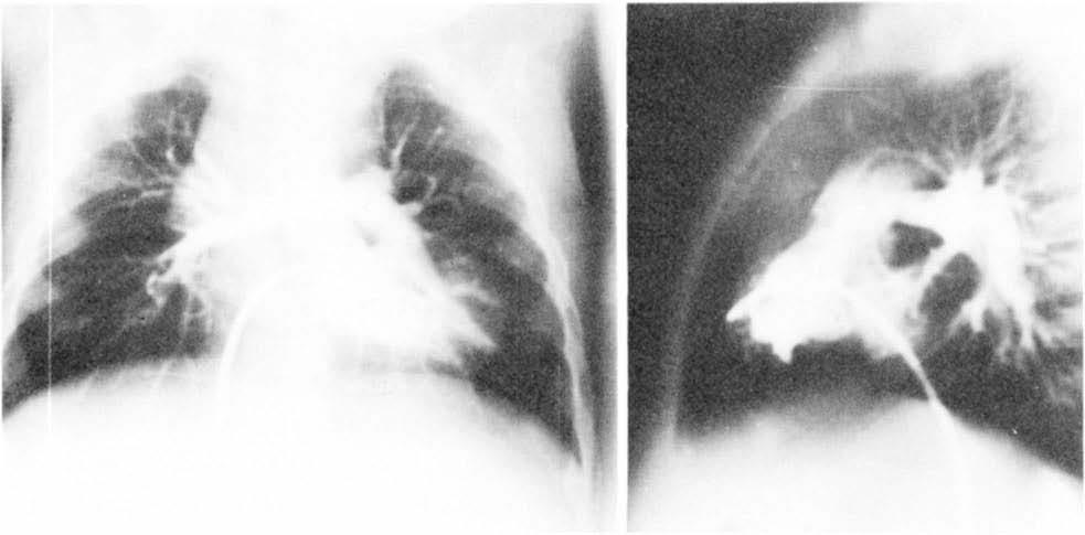 Obstruction After Aorta-to-Right Pulmonary Artery Shunt been associated with an increased operative mortality [6, 10, 261.