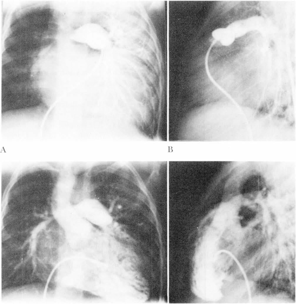 GAY AND EBERT C D FIG. 2. Angiography following Waterston shunt. Pulmonary arteriogram (A, frontal; B, lateral) demonstrates total diversion of pulmonary arterial flow to the left lung.