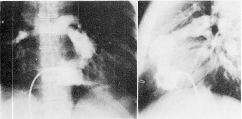 Obstruction After Aorta-to-Right Pulmonary Artery Shunt defect in the right pulmonary artery [14].