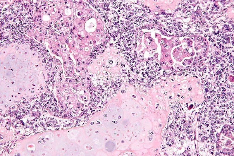 Uterine Carcinosarcoma (UCS) Cancer that develops in the uterus Tumor displays histological features of both endometrial carcinoma and sarcoma Rare and aggressive form cancer (< 5% of all uterine
