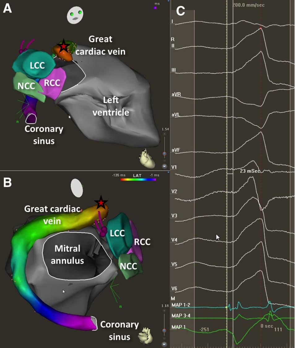 Al Aref et al Differentiation of Left Ventricular Arrhythmias 619 Figure 3. ECG and electrophysiological characteristics of left posterior fascicular ventricular tachycardia (VT).