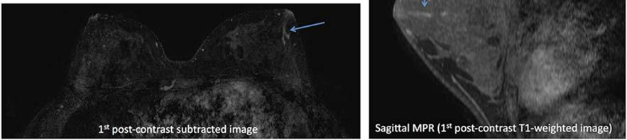 guided biopsy when no sonographic correlate is found, as over 1 in 5 sonographically occult MRI detected lesions are malignant (1).