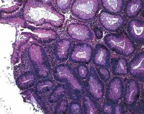 MAKKAR AND COLLEAGUES adenomas, and sessile serrated polyps (sessile serrated adenomas).
