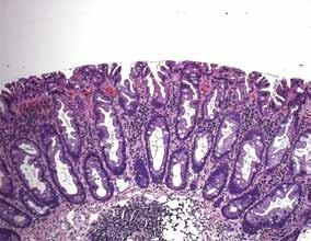 SESSILE SERRATED POLYPS One study found that large serrated polyps were associated with a threefold higher risk of synchronous advanced neoplasia Figure 2.