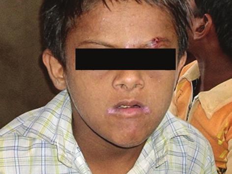 Figure 8: 12-year-old male showing fissured tongue DISCUSSION Down syndrome individuals are reported to exhibit an increased susceptibility to infections due to various factors such as increased