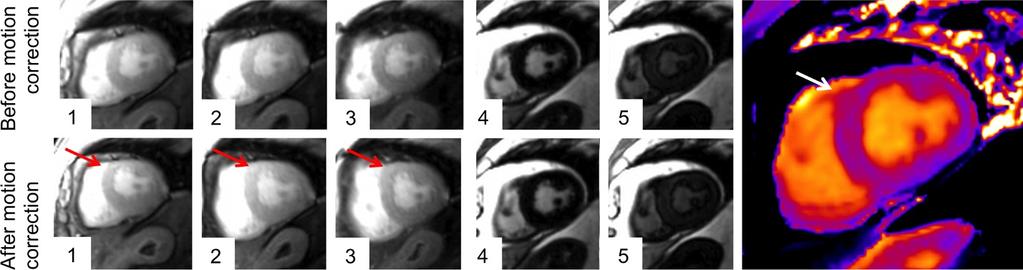 In the corresponding map the artifact is hardly recognizable by visual assessment (white arrow). similar to that used in this study [17,18].