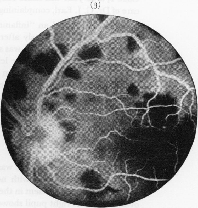Small superficial linear haemorrhages were present in the retina, being related to the superior and inferior temporal vessels in both eyes.