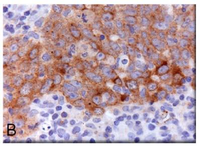 Nasopharyngeal carcinoma (NPC) frequent epithelial cell cancer with a high incidence rate in Southeast