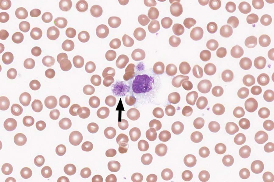 VPBS-11 Platelet, giant 937 96.2 Educational Megakaryocytic cell 19 2.0 Educational The blood component identified is a giant platelet, as correctly identified by 96.2% of the participants.