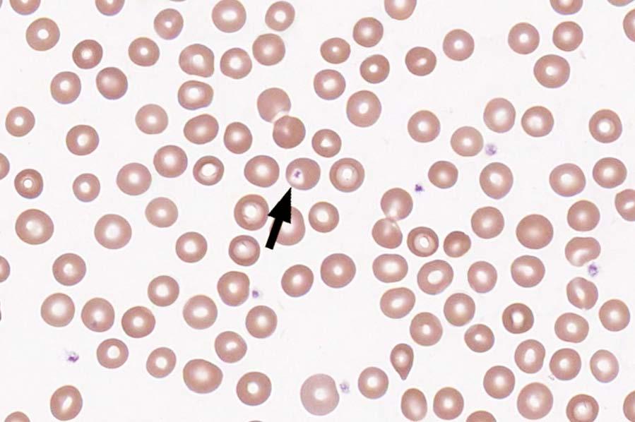 VPBS-12 Erythrocyte w/platelet 935 96.0 Educational Platelet, normal 32 3.3 Educational The cell identified is an erythrocyte with an overlying platelet, as correctly identified by 96.