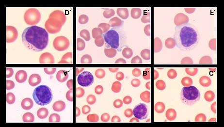MPS cases may have certain morphological features evident on peripheral blood smear review.