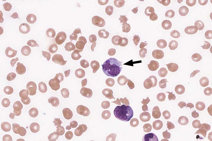 VPBS-03 Monocyte 920 94.5 Educational Monocyte, immature 21 2.2 Educational Neutrophil, metamyelocyte 10 1.0 Educational The image is that of a monocyte, as correctly identified by 94.