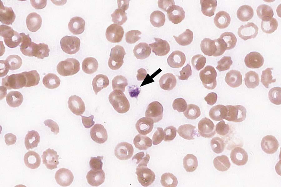 VPBS-04 Platelet, giant 835 85.8 Educational Platelet, normal 96 9.9 Educational Megakaryocytic cell 15 1.5 Educational Platelet hypogranular 15 1.