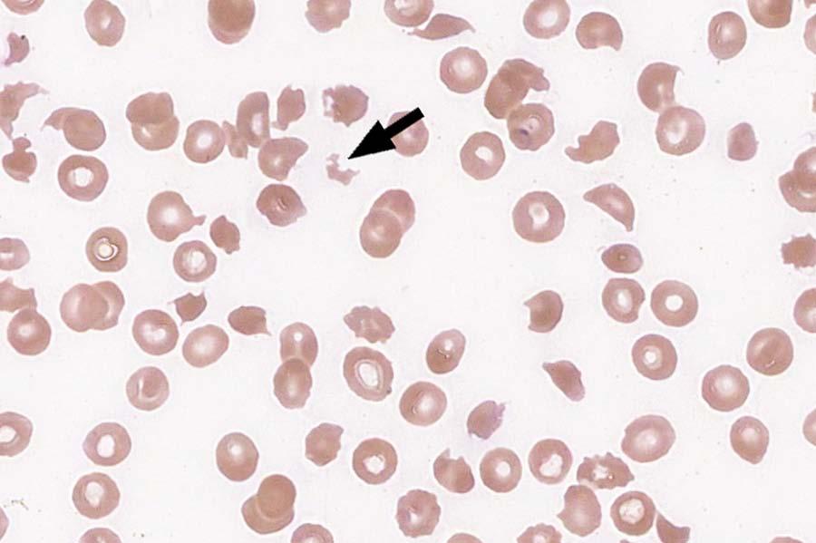 VPBS-05 Fragmented red cell 953 97.8 Educational Acanthocyte (spur cell) 17 1.8 Educational The image is that of a fragmented red blood cell, as correctly identified by 97.8% of participants.
