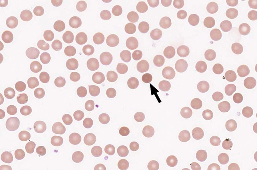 Cell Identification VPBS-08 Spherocyte 822 84.4 Educational Erythrocyte, normal 84 8.6 Educational Micro w/central pallor 60 6.2 Educational The cells identified are spherocytes, as identified by 84.