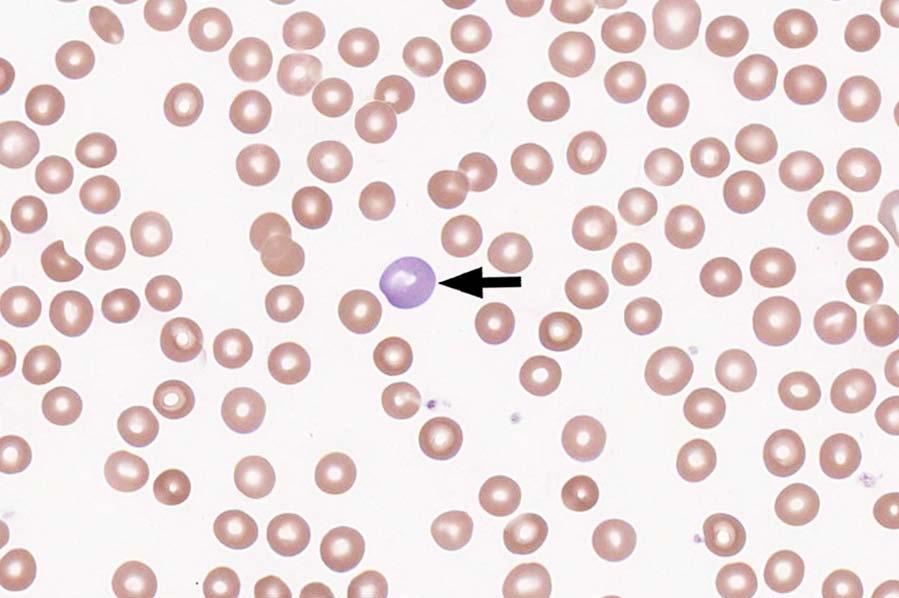 VPBS-09 Polychromatophilic RBC 952 97.7 Evaluation Macrocyte oval/round 17 1.8 Evaluation The cells identified are polychromatophilic red cells, as correctly identified by 97.7% of the participants.