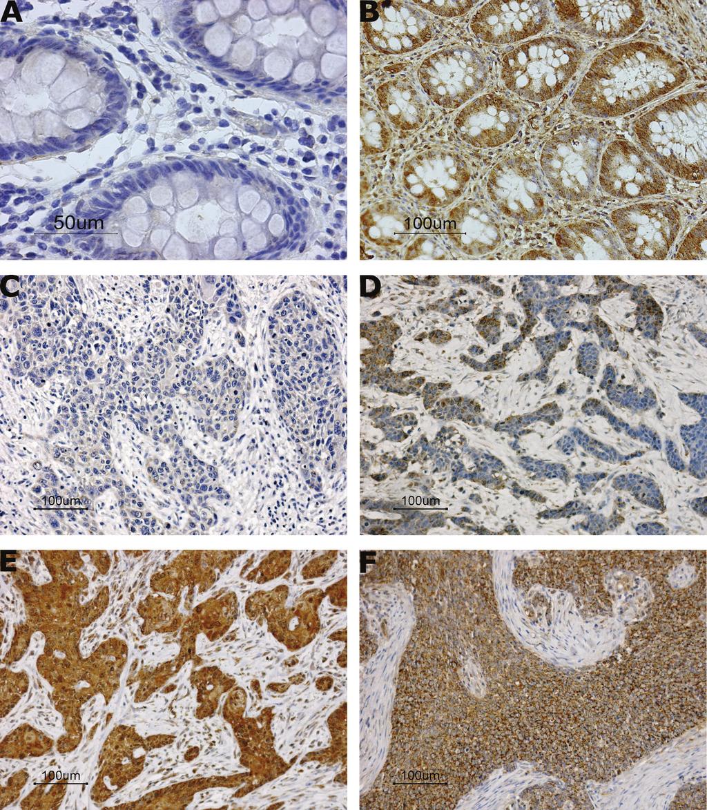 Figure 1. MICA immunohistochemical staining in control intestine tissue and in HNSCC tumours.