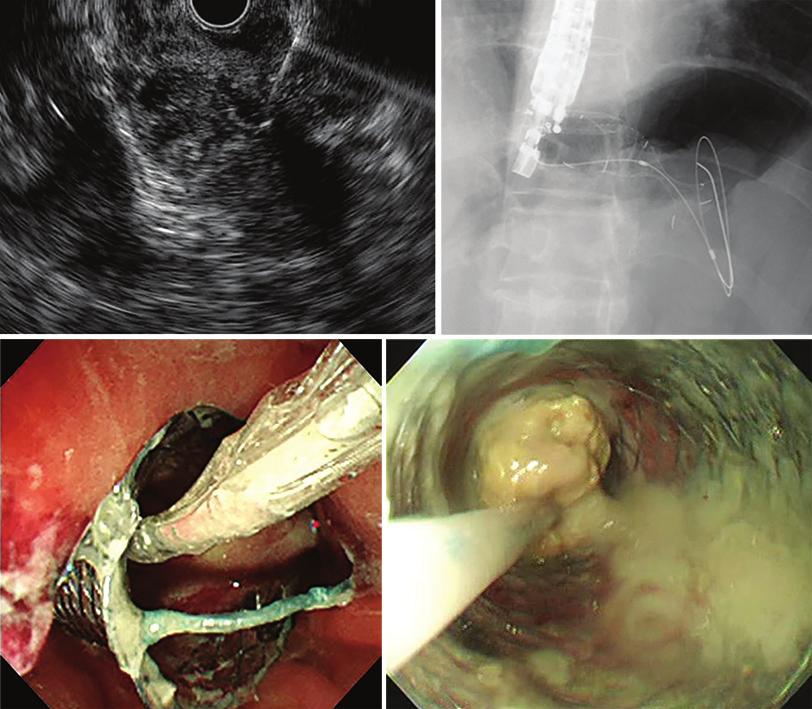 the fistula was identified on the endoscope view while slowly pulling on the echoendoscope.