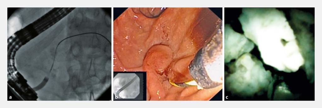 Fig. 1 a Radiopaque stone in the main pancreatic duct (MPD), b wire-guided cannulation of MPD with SpyGlassDS catheter (Boston Scientific, Natick, Mass, US) after pancreatic sphincterotomy, c direct