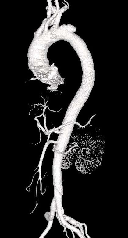 Branched stent-graft