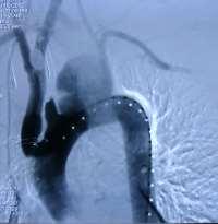 left carotid artery LSA bypass