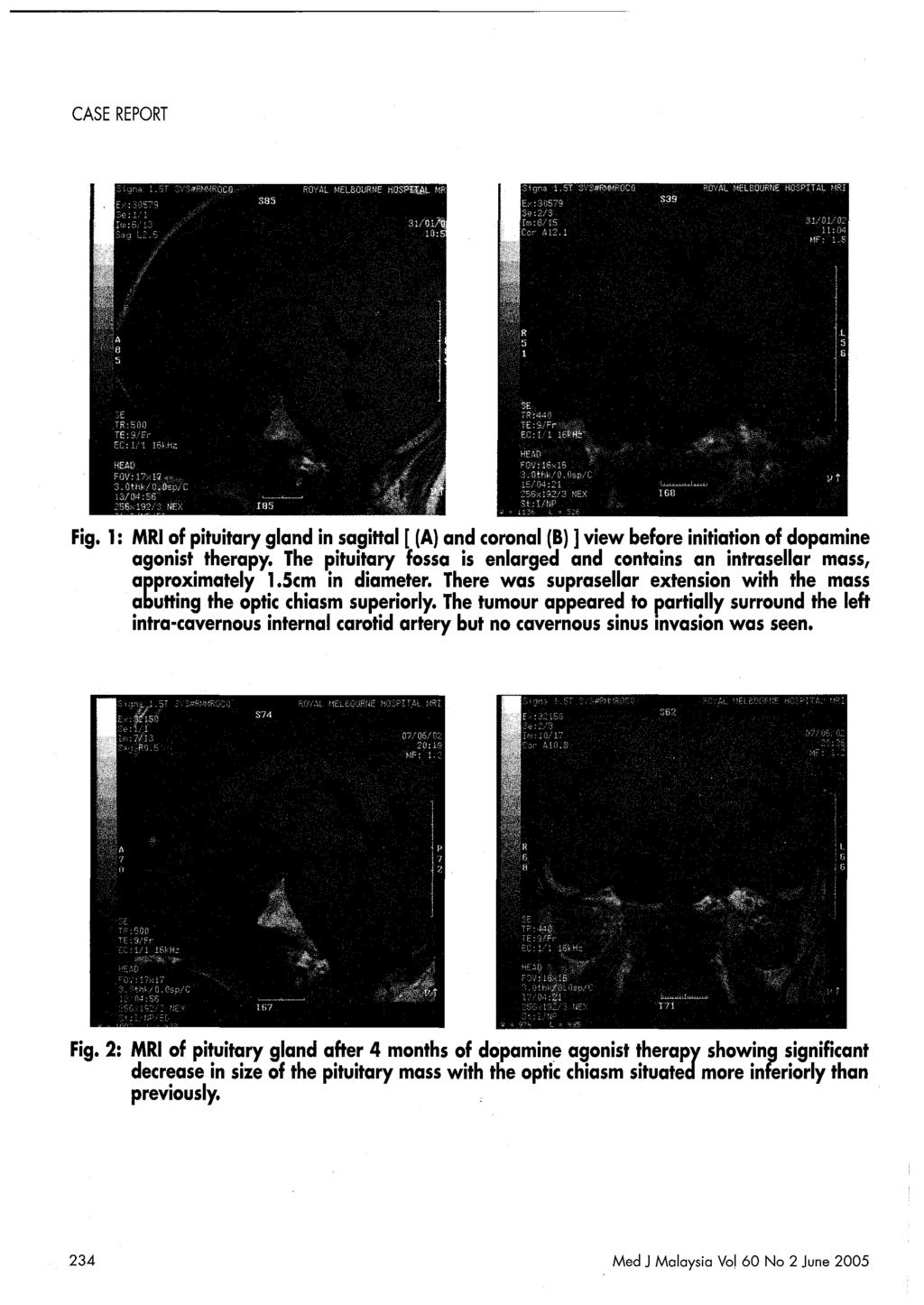 Fig. 1: MRI of pituitary gland in sagittal [ (A) and coronal (B) ] view before initiation of dopamine agonist therapy.