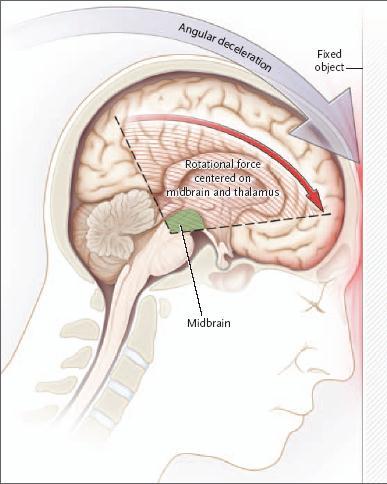 bleeding in or over brain (hemorrhage or hematoma) Coup and Contra-coup Mechanical injury to hypothalamus & pituitary in TBI